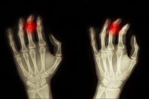 צילום רנטגן של שברים באצבעות כף היד בשתי בידיים